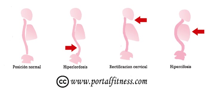 Postura: Hiper Lordosis e Hiper Cifosis