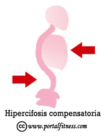 Hipercifosis Compensatoria