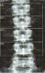 Dolores de columna ¿se pueden prevenir?